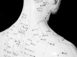 acupuncture