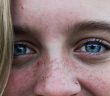 Pimple Remedies